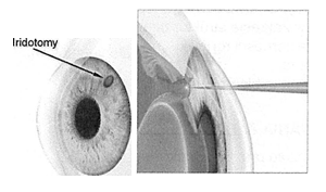 irydotomia laserowa